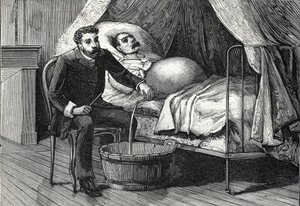 Patient med fremskreden levercirrhose, læge, der udfører en punktering (gravering) 1888 af French School