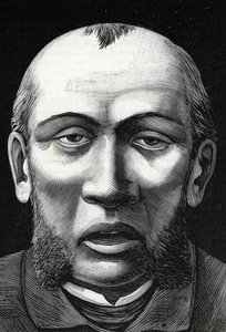 Patient med cerebral blødgøring (gravering) 1888 af French School