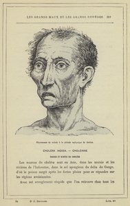 Fysiognomi af patienten under asfyksiperioden af ​​kolera (farve litho) af French School