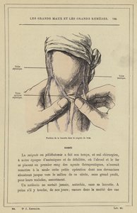 Placering af lancetten i armblødningen (farve litho) af French School