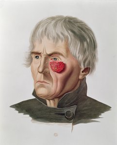 Hudsygdom før en operation, fra Selecta Praxis Medico-Chirurgica af Alexander Auvert, Paris, 1856 af French School