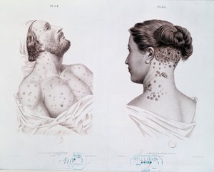 Symptomer på syfilis hos mænd og kvinder, fra en lægebog, ca. 1850-60 af French School