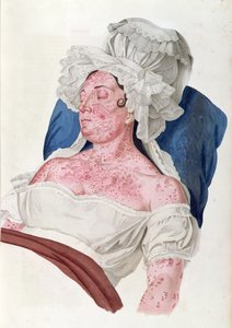 Kvinde med skarlagensfeber, fra en bog af Baron Jean Louis Alibert (1768-1837) indgraveret af Choupard, 1833 af French School
