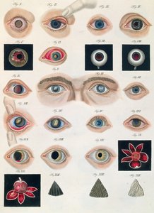Beskrivelse af medfødte øjenanomalier, fra kliniske præsentationer af sygdomme og visuelle defekter i det menneskelige øje, af Friedrich August von Ammon (1799-1861) 1838 af German School