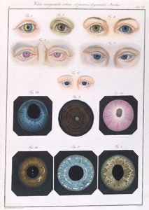 Beskrivelse af medfødte øjenanomalier, fra kliniske præsentationer af sygdomme og visuelle defekter i det menneskelige øje, af Friedrich August von Ammon (1799-1861) 1838 af German School