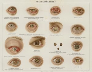 Øjenlidelser (farve litho) af German School