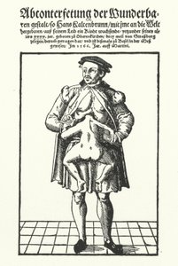 Hans Kaltenbrunn und sein unentwickelter siamesischer Zwilling