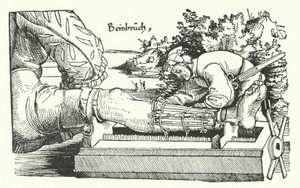 Behandling af et brækket ben (gravering) af German School