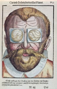 Behandling af en øjensygdom, fra Ophthalmodouleia af Georg Bartisch (1535-1636) udgivet i Dresden i 1583 (træblok i farver) af German School