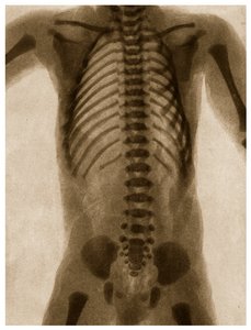 Røntgen af en menneskelig torso ca. 1890 af German School