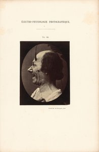 Fotografisk elektrofysiologi, figur 39 af Guillaume Benjamin Duchenne