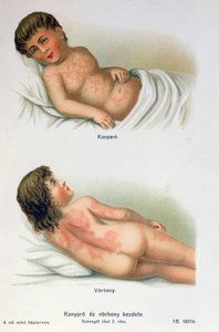 Mæslinger og skarlagensfeber, fra en familielægebog, ca. 1900 af Hungarian School