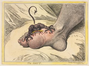 Gigten af James Gillray
