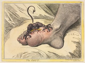 Gigten, 1799. af James Gillray