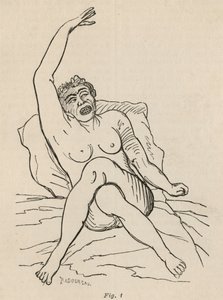Hysterisk epilepsi, anfald, forvridninger, fig. 1 fra 