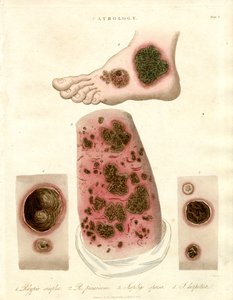 Patologiske hudsygdomme - Pityria, impetigo og syfilis