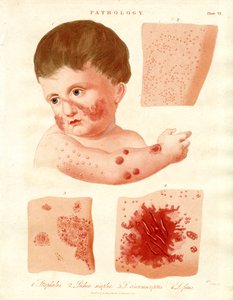 Patologiske hudsygdomme