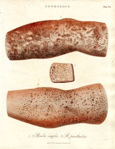 Udbrud i huden - Roseola simplex og Roseola paristhmitica