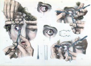 Operation af en strabismus, plade fra "Traite Complet de l