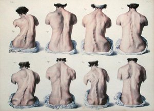 Spinal deformiteter, plade fra 
