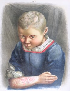 Favus, fra en bog af Daniel Cornelius Danielssen (1815-94) 1892 af Norwegian School