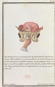 Tværsnit af et barn, der trækkes ud af livmoderen med armen, fra en bog af Madame Angelique Le Boursier du Coudray (1714-94), graveret af J. Robert, 1783 af P. Chapparre