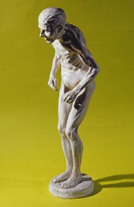 Figur af en kvinde med Parkinsons sygdom (gips) af Paul Marie Louis Pierre Richer