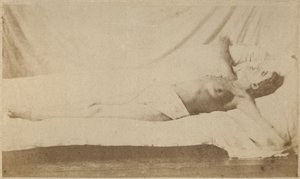 Hysterisk epilepsi, anfald, korsfæstelse, plade VI fra "Iconographie Photographique de La Salpetriere" af Bourneville et P. Regnard, Paris, 1876 (albumenprint)