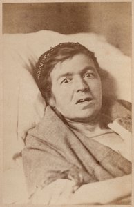 Hysterisk epilepsi, ansigtssammentrækning, plade VIII fra 
