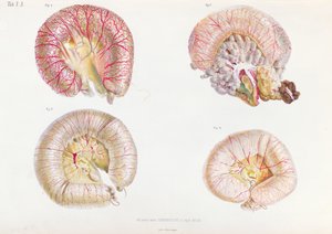 Den ydre overflade af tarmene inficeret med kolera, fra Anatomie Pathologique du Cholera Morbus, af Nikolai Ivanovich Pirogov (1810-81) udgivet i St. Petersborg, 1849 af Russian School