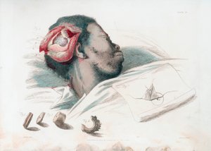Visning af sår i kraniet efter trephination og fjernelse af knust knoglestykke nederst til venstre, 1821 af Thomas Landseer