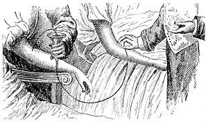 Blodtransfusion, c1880 af Unbekannt