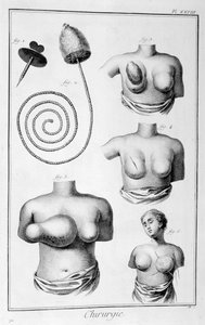 Brystkirurgi, 1751-1777 af Unbekannt