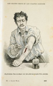 Maling af et sår med en antiseptisk opløsning, c1890 af Unbekannt