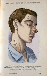 Symptomer på den tertiære fase af syfilis, c1800-tallet af Unbekannt
