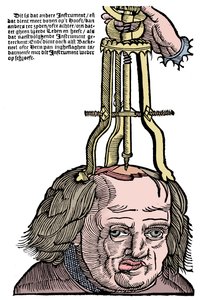 Trephination, 1593 af Unbekannt