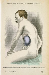 Typisk forstørret milt hos en malariapatient, c1890 af Unbekannt