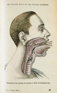 Brug af et laryngoskop til at hjælpe med at fjerne en polyp fra halsen, c1890 af Unbekannt