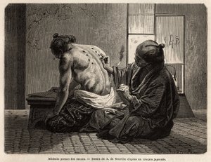En læge poserer moxas (små kegler brændt i bestemte dele af kroppen), en forebyggende behandling mod forskellige symptomer fra fordøjelsesbesvær til manglende appetit, gråd og tandpine, ansætter to gange om året og har fastsat tid af japanerne. Engravi af Unknown artist