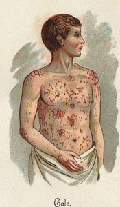 Børnesygdomme: Fnat. I "Den nye naturlige medicin"" af F.E. Bilz. af Unknown artist