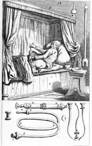Clystère (til lavementer) af Johannes Sculptetus "" Armamentarium Surgical"". Venedig 1665 af Unknown artist