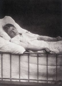 Hystero Epilepsie - Stivkrampeangreb i "" Fotografisk ikonografi af Salpétrière: service of Mr. Charcot"" af Paul Regnard og Bourneville af Unknown artist