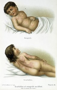 Skarlagensfeber og mæslinger - 1800-tallet af Unknown artist
