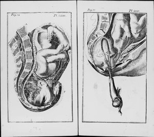 Fødsel af en baby med brug af pincet Plade fra "An abridgement of the practice of midwifery"" af William Smellie (1697-1763) af Unknown artist