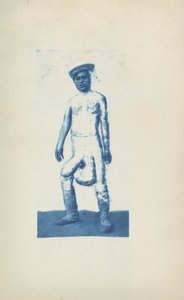 Elefantiasis, ca. 1870