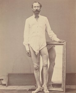 Skudsår af midterste tredjedel af venstre lårben, 1865-67.