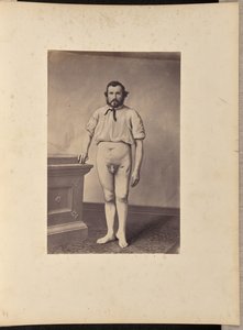Vellykket excision af hovedet på venstre lårben for skudfraktur af William H. Bell