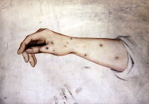 Studie af en underarm med hudtilstand, ca. 1850 (akvarel på papir) af William Lover