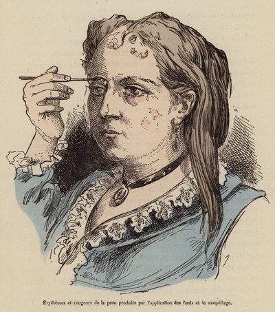 Kvinde med hududslæt og rødme forårsaget af brug af makeup (farvet gravering) af (after) French School