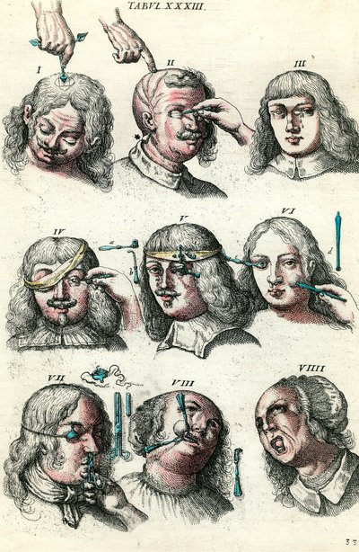Kirurgi i det 18. århundrede: Trepanation og operation af øjet og ansigtet. Indgravering i "Institutions chirurgicale" af Lorenz Heister af Anonymous Anonymous